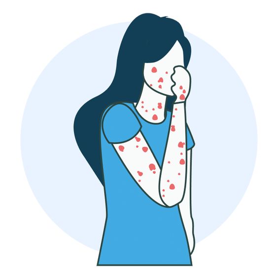 Skin Rash: Types, Symptoms, Causes, Diagnosis and Treatments